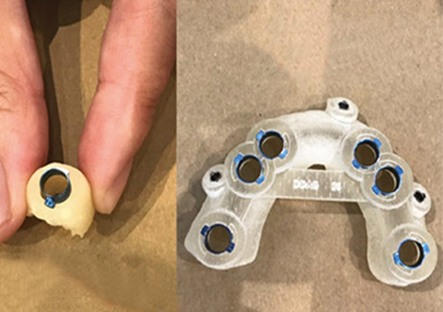 3D列印應於牙科醫療的植牙模型